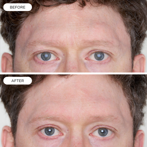 Before and after comparison showing the eye area of an adult after using Youth Potion Advanced. The after image shows a visibly smoother-looking under-eye area and reduced appearance of fine lines around the eyes.